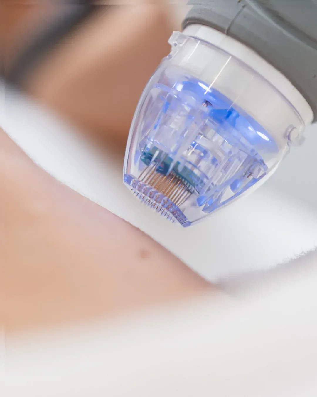 Wat is microneedling?