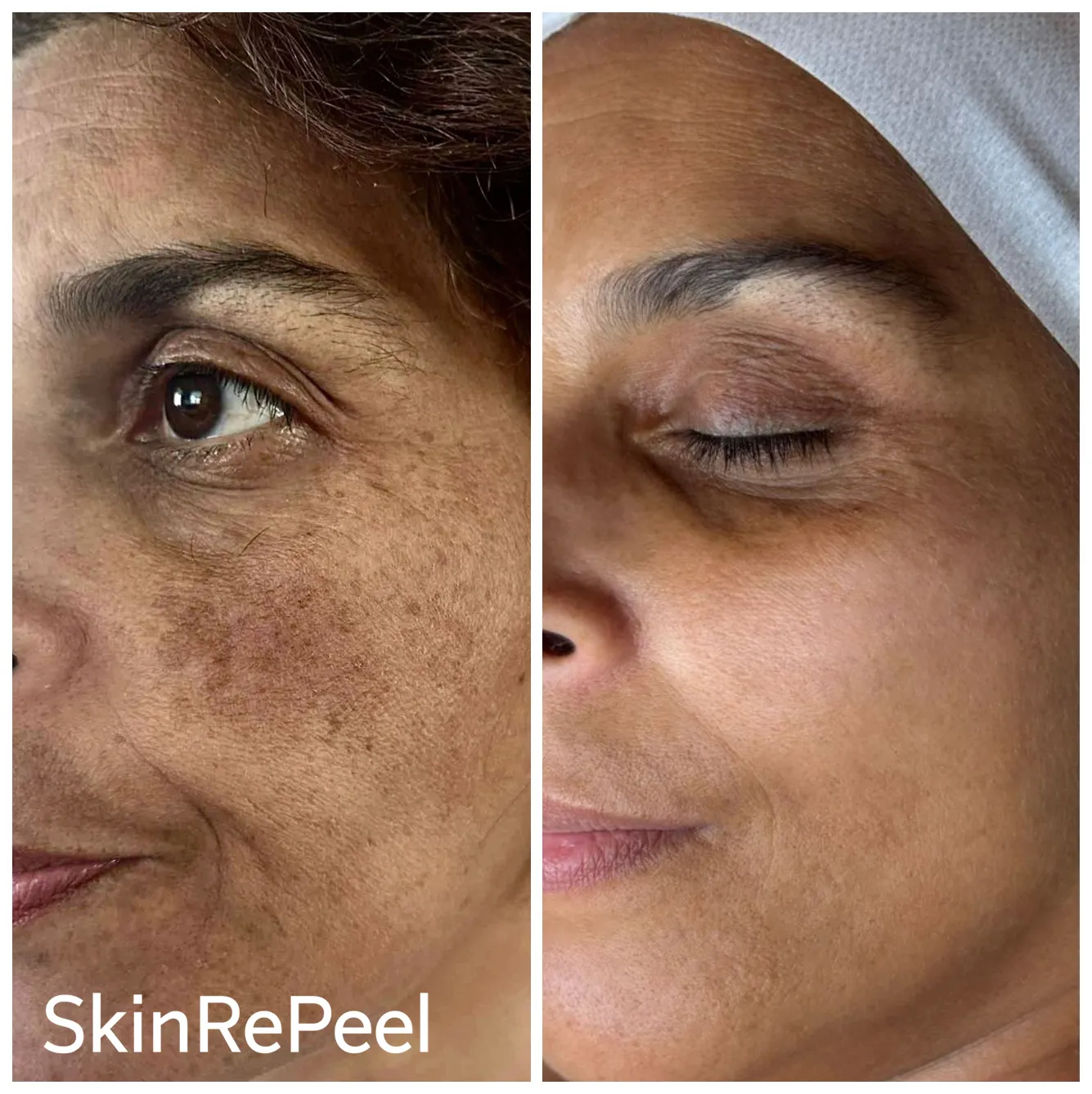 Wie krijgt melasma?