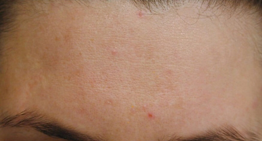 Acne na Acne na