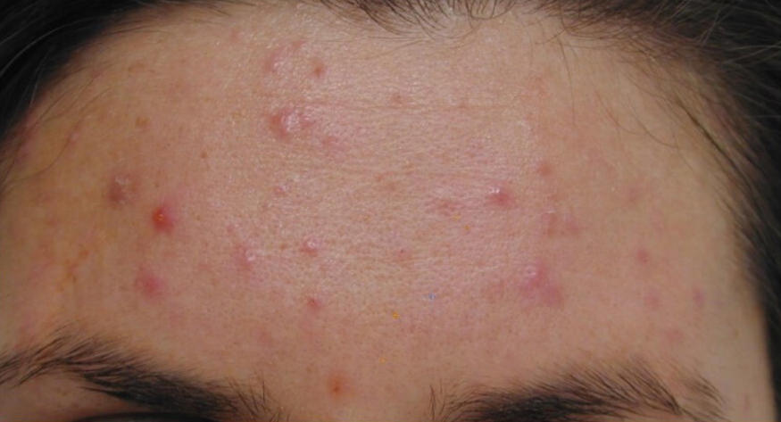 Acne voor Acne voor