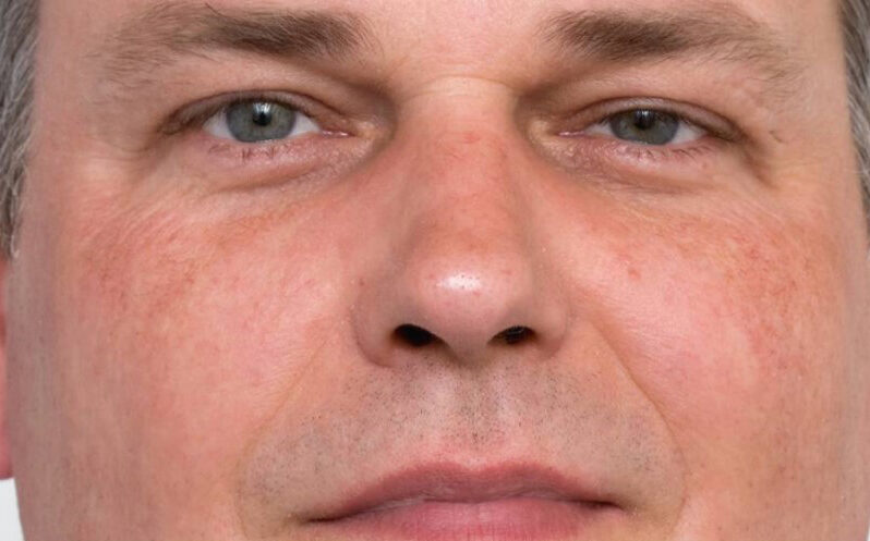 Rosacea na Rosacea na