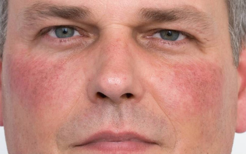 Rosacea voor