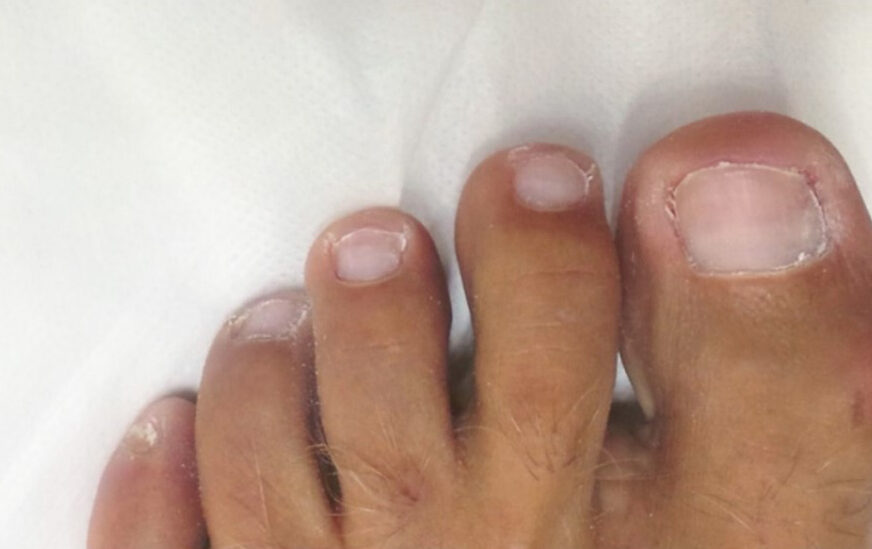 Schimmelnagels na Schimmelnagels na
