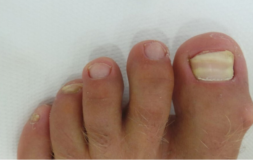 Schimmelnagels voor Schimmelnagels voor